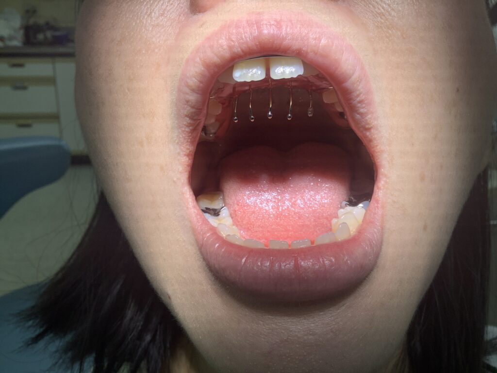 女子做核酸检测，意外发现舌部肿块…医生：这癌恶性程度高、生长快|舌癌|口腔癌|唐琦_新浪新闻